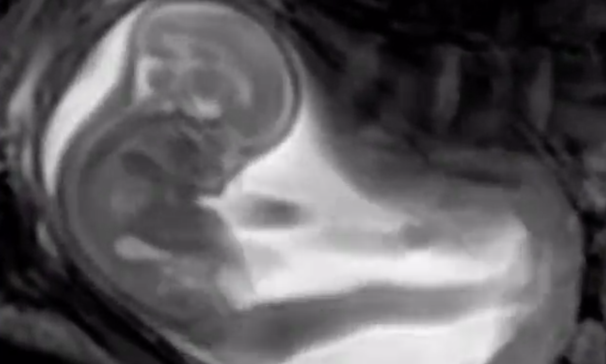 【ぎゃあああ】MRIでお腹の赤ちゃんを撮影した結果！→衝撃的映像に！ 秒刊SUNDAY