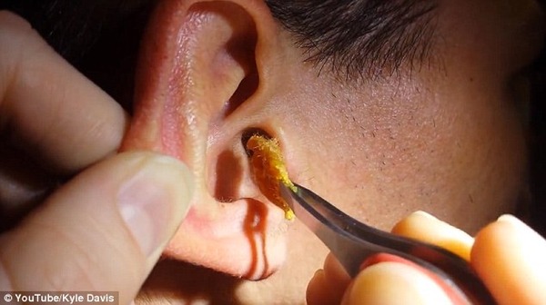 でかい 耳垢 耳垢が多い原因は病気 巨大で大きいからビックリした