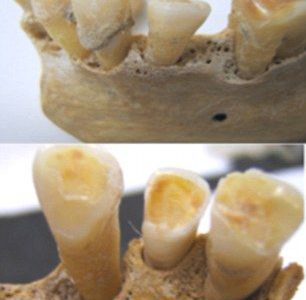 衝撃の事実！歯ブラシの無い古代人のほうが虫歯が少ないという研究結果が発表される