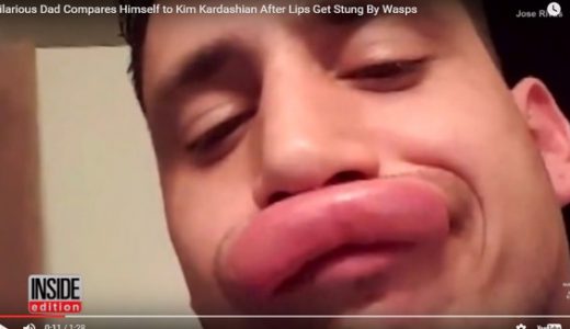 【閲覧注意】上唇をハチにさされた男性、セクシー唇の自撮り動画がおもしろすぎるとネットで話題に！